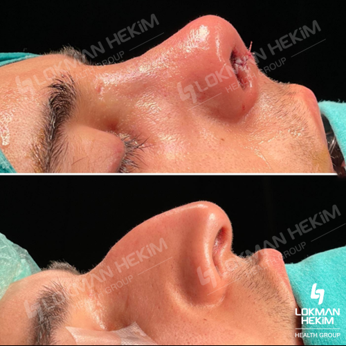 Septoplasty Before / After photo